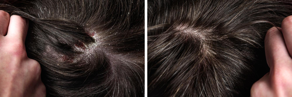 Scalp Psoriasis and Seborrhoeic Dermatitis