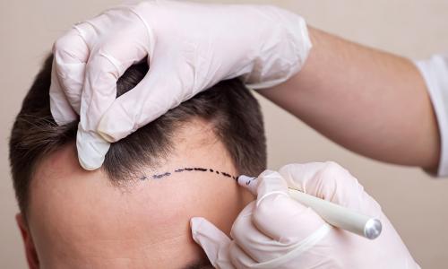 Hair transplant- fue-no visible scar-minimally invasive-fast recovery