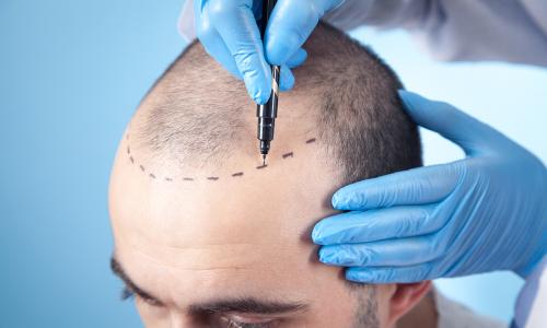 Best hair transplant – patient information sheet