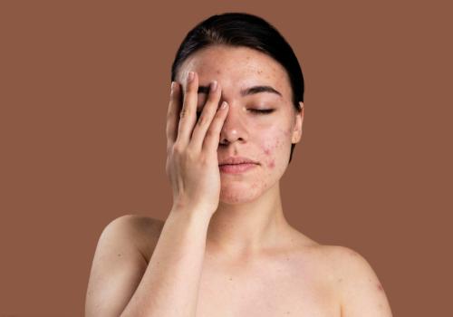 Pigmentation and Acne: Why Your Skin Needs More Than Just Creams