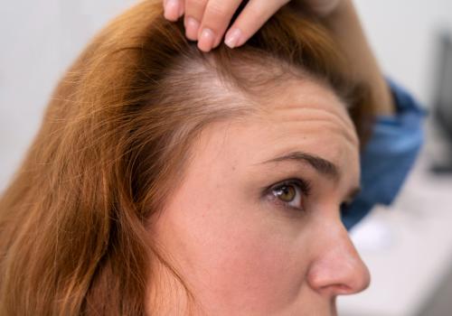 Understanding Telogen Effluvium (TE) and Hair Shedding