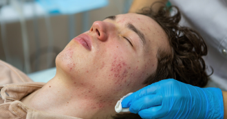 Acne Scars Treatment