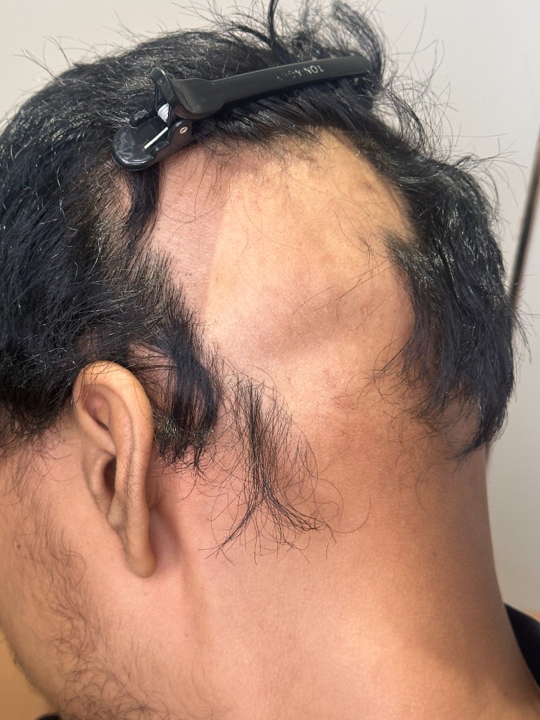 Advanced Treatment for Children with Alopecia Areata