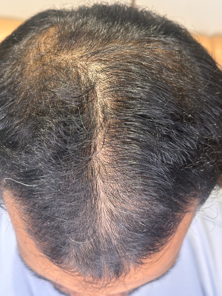 Androgenetic Alopecia