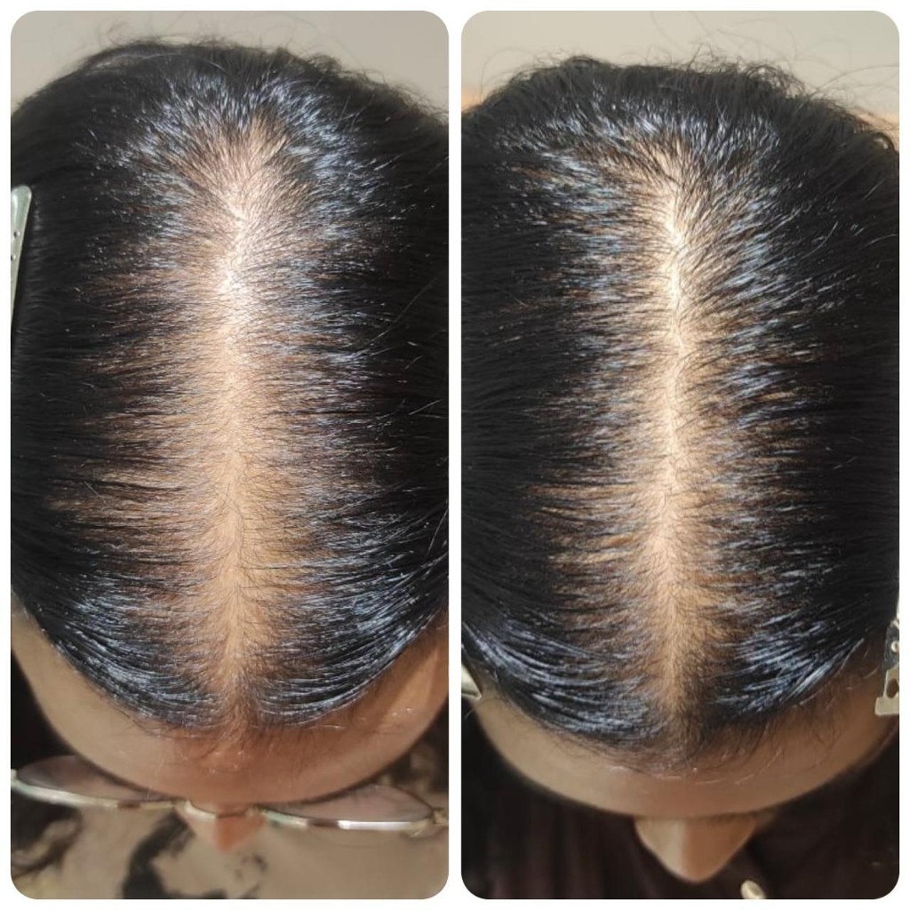 Female Pattern Hair Loss