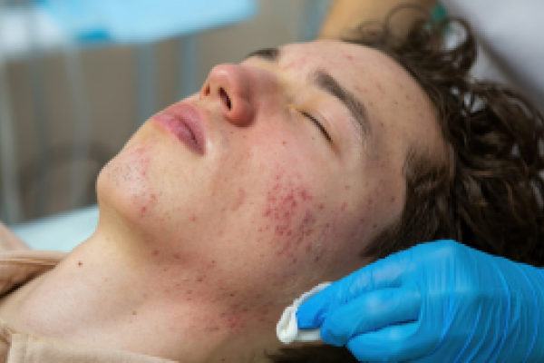 Acne Scars Treatment