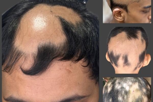 Alopecia Areata