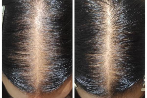 Female Pattern Hair Loss