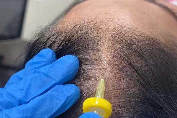 Follicular O₂ Boost Therapy at RD Clinic